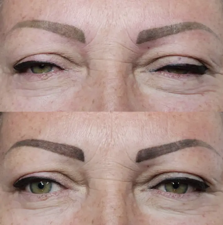 laser removal eyebrows
