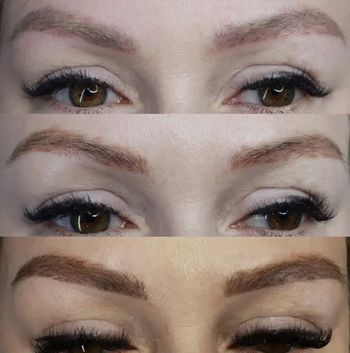eyebrow tattoo removal before and after