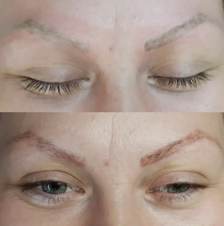 cosmetic tattoo removal