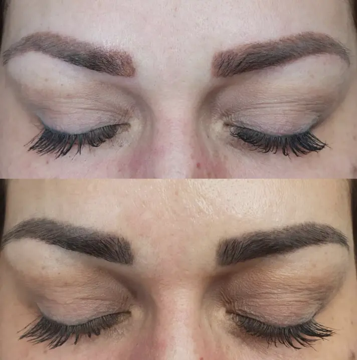 eyebrow removal