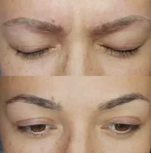 laser eyebrow tattoo removal