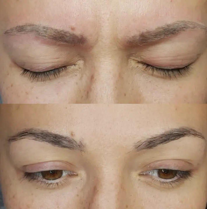 laser eyebrow tattoo removal