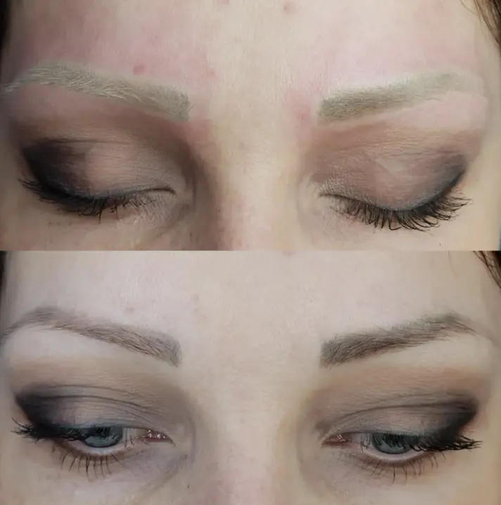 eyebrow tattoo laser removal