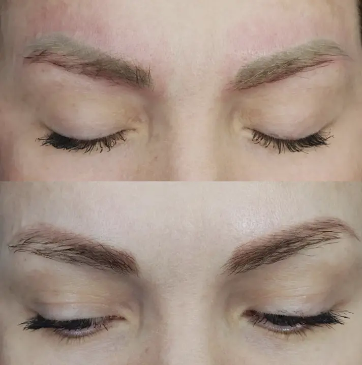 eyebrow laser tattoo removal