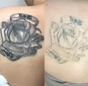 laser tattoo removal healed
