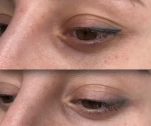 eyebrow treatment